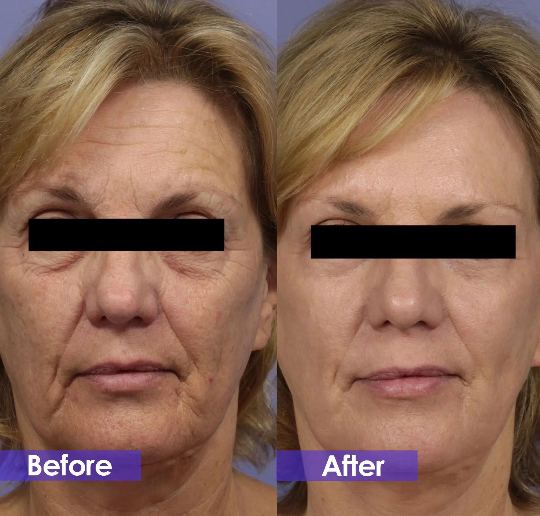 What is the best skin rejuvenation treatment